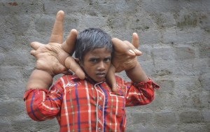 У Индийского мальчика из-за недуга выросли огромные руки (+Фото)