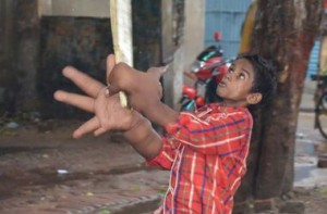 В Индии врачи уменьшили мальчику гигантскую руку