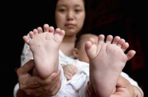 В Китае родился ребенок с 31 пальцем и четырьмя ладонями