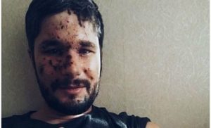 Раненый в Авдеевке британский журналист рассказал о произошедшем
