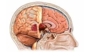 Опухоли головного мозга и методы их лечения